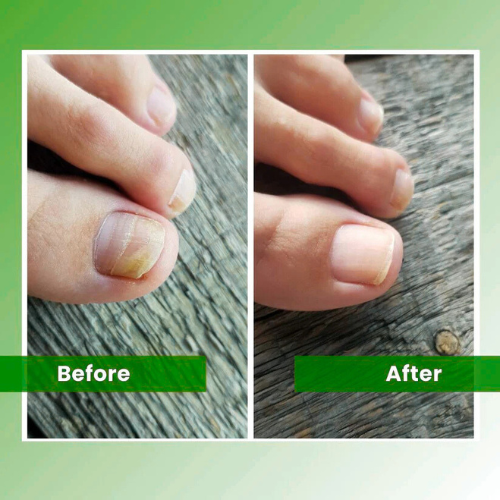 Vivadrop™ - Nail Fungus Laser