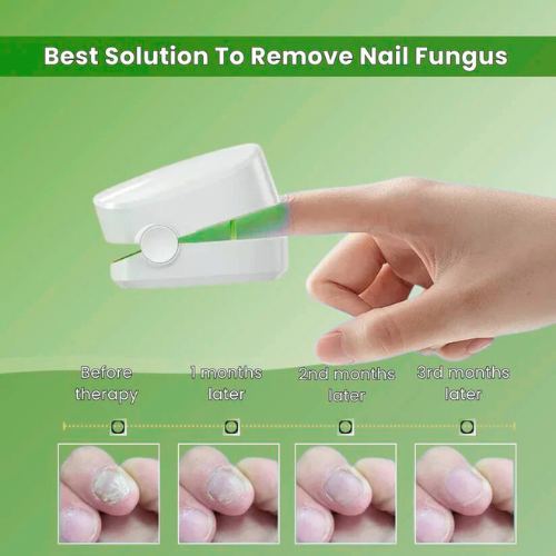 Vivadrop™ - Nail Fungus Laser